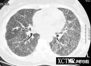 【病例】肺泡微结石症1例CT影像表现
