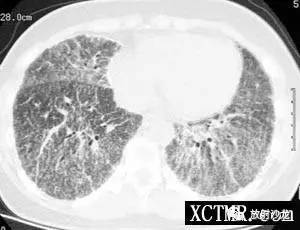 【病例】肺泡微结石症1例CT影像表现 【病例】肺泡微结石症1例CT影像表现