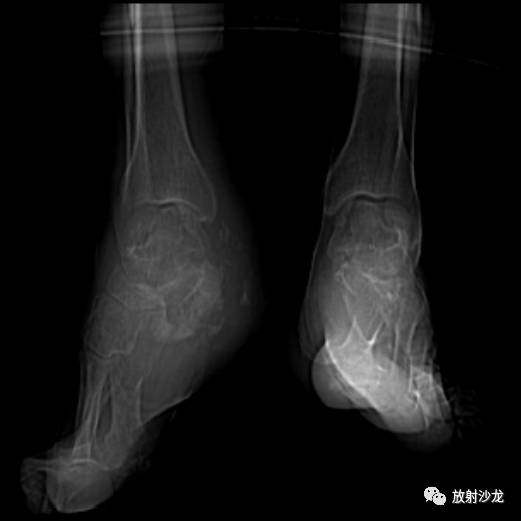 【病例】右跟骨慢性化脓性骨髓炎1例X线CT 【病例】右跟骨慢性化脓性骨髓炎1例X线CT