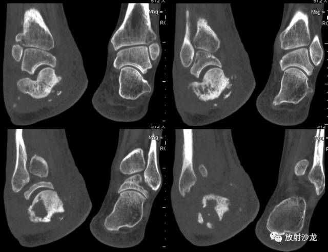 【病例】右跟骨慢性化脓性骨髓炎1例X线CT 【病例】右跟骨慢性化脓性骨髓炎1例X线CT