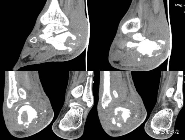 【病例】右跟骨慢性化脓性骨髓炎1例X线CT 【病例】右跟骨慢性化脓性骨髓炎1例X线CT