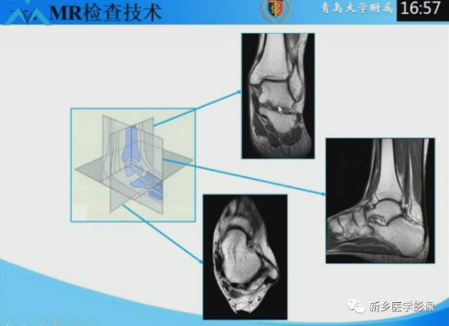 【PPT】足踝部MRI诊断