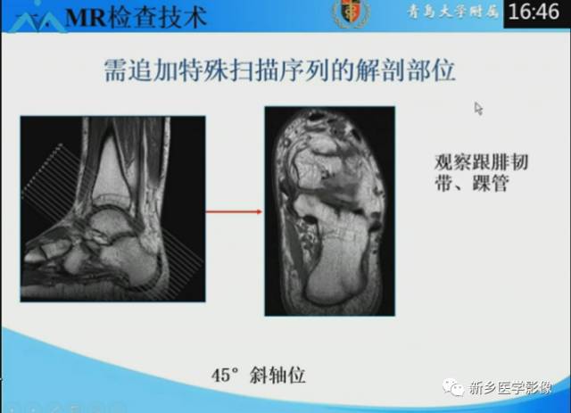 【PPT】足踝部MRI诊断