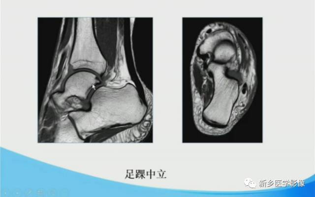 【PPT】足踝部MRI诊断