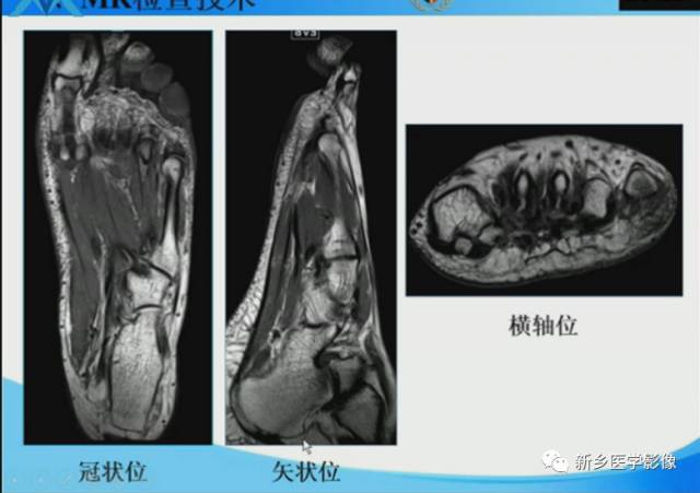 【PPT】足踝部MRI诊断