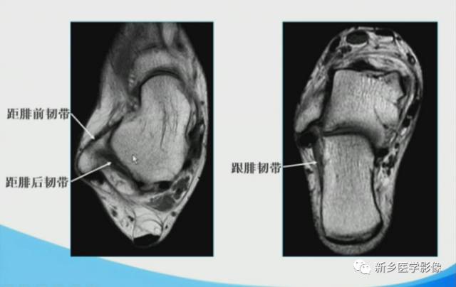 【PPT】足踝部MRI诊断