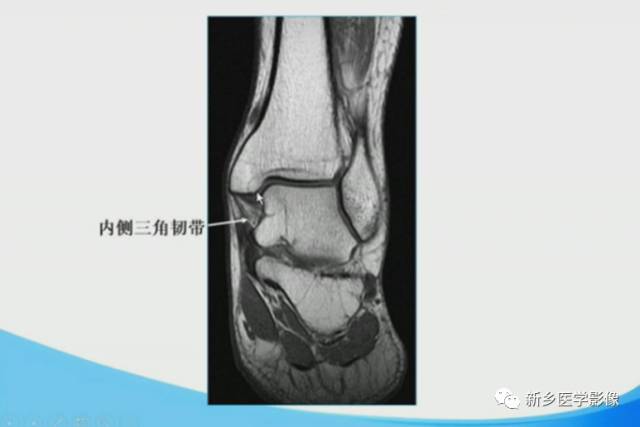 【PPT】足踝部MRI诊断