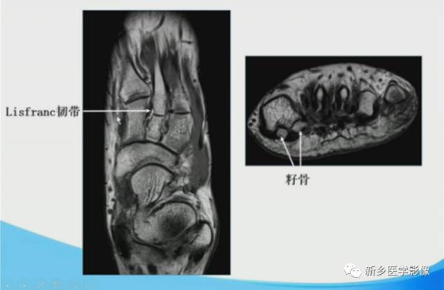 【PPT】足踝部MRI诊断