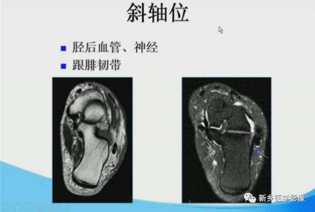 【PPT】足踝部MRI诊断