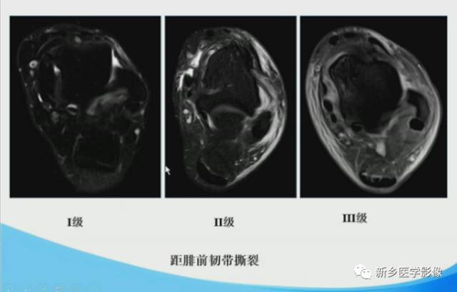 【PPT】足踝部MRI诊断