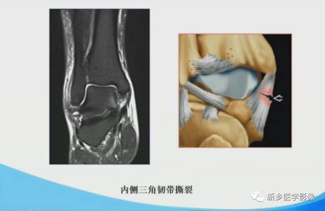 【PPT】足踝部MRI诊断