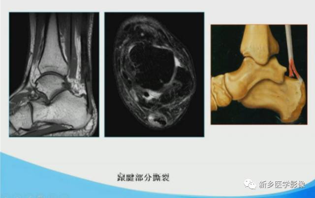 【PPT】足踝部MRI诊断