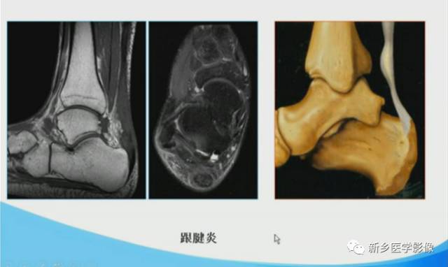 【PPT】足踝部MRI诊断