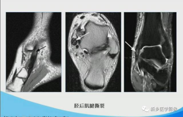 【PPT】足踝部MRI诊断