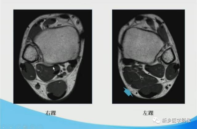 【PPT】足踝部MRI诊断