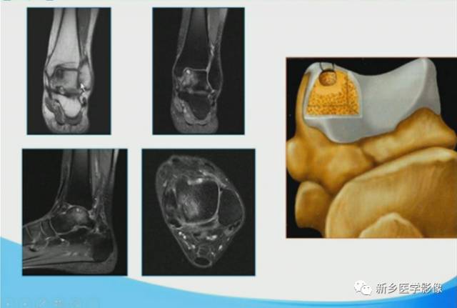 【PPT】足踝部MRI诊断