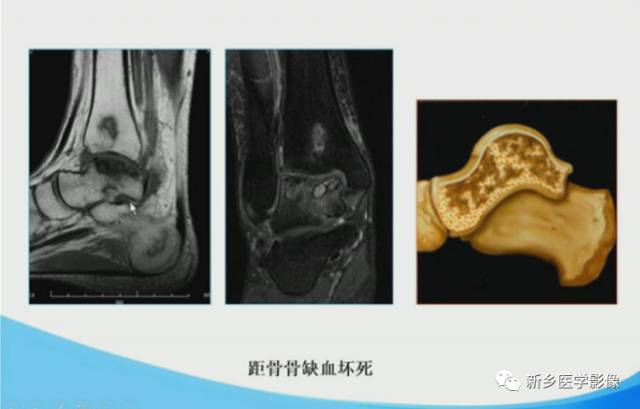 【PPT】足踝部MRI诊断