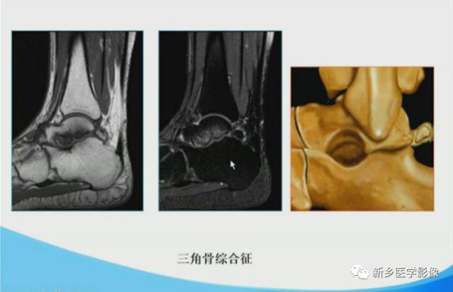 【PPT】足踝部MRI诊断