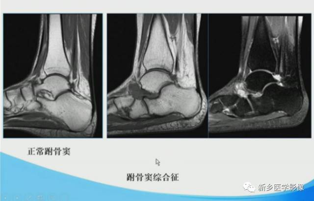 【PPT】足踝部MRI诊断
