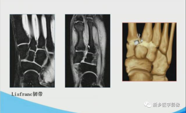 【PPT】足踝部MRI诊断