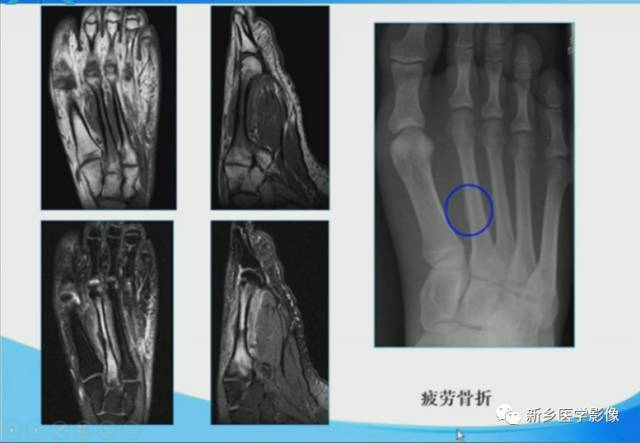 【PPT】足踝部MRI诊断