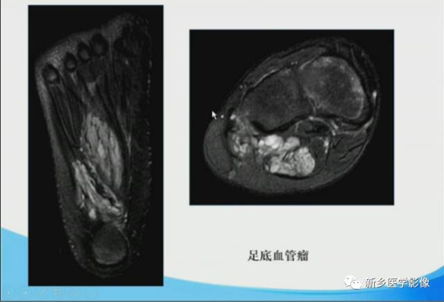 【PPT】足踝部MRI诊断