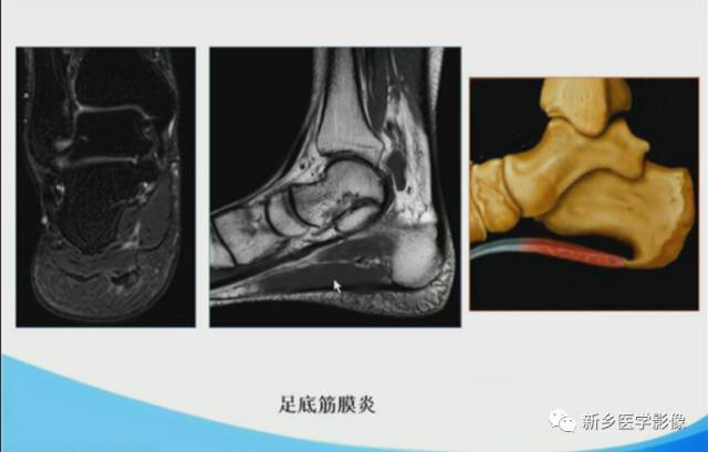【PPT】足踝部MRI诊断