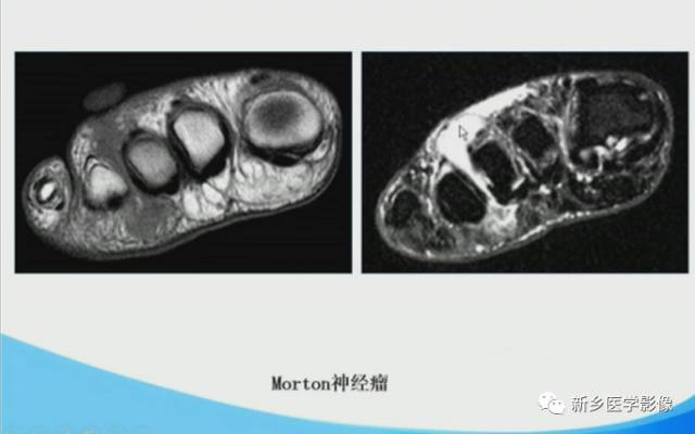 【PPT】足踝部MRI诊断