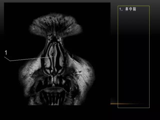 【PPT】MRI下的眼部及鼻窦解剖图