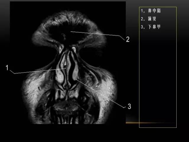 【PPT】MRI下的眼部及鼻窦解剖图