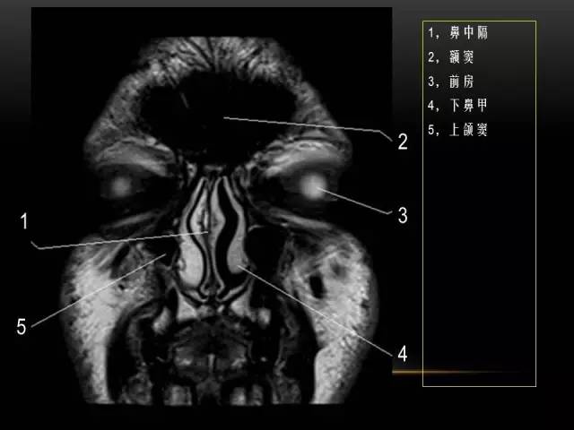 【PPT】MRI下的眼部及鼻窦解剖图