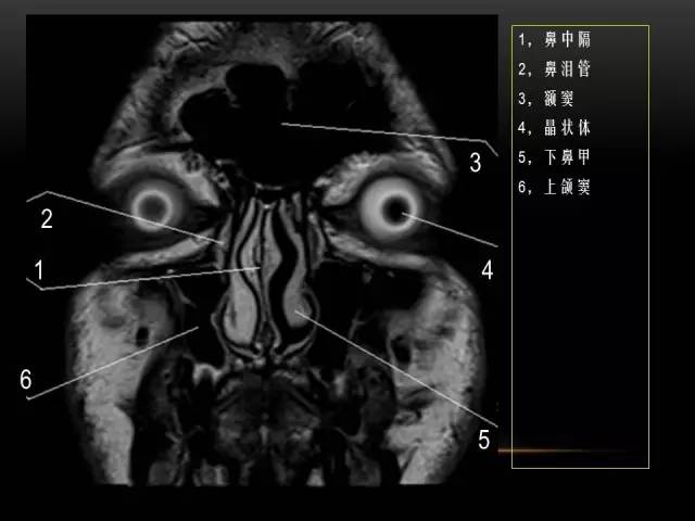 【PPT】MRI下的眼部及鼻窦解剖图
