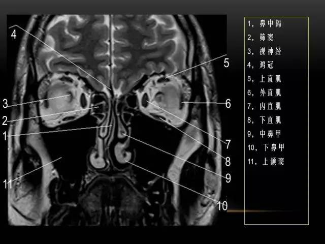 【PPT】MRI下的眼部及鼻窦解剖图