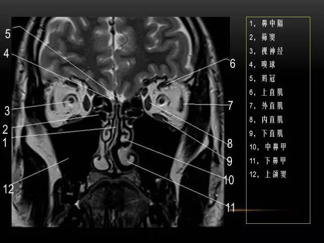 【PPT】MRI下的眼部及鼻窦解剖图