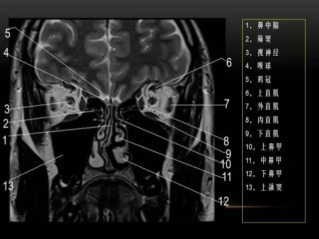 【PPT】MRI下的眼部及鼻窦解剖图