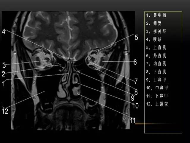【PPT】MRI下的眼部及鼻窦解剖图