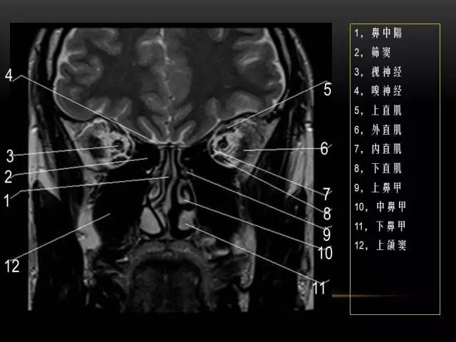 【PPT】MRI下的眼部及鼻窦解剖图