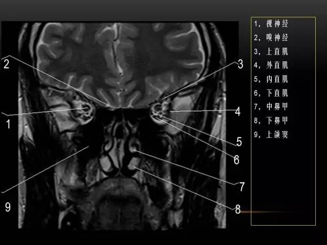 【PPT】MRI下的眼部及鼻窦解剖图