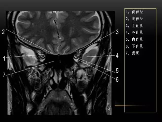 【PPT】MRI下的眼部及鼻窦解剖图