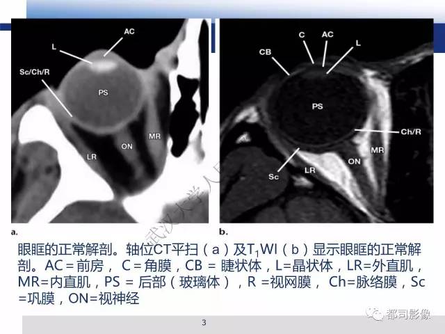 【PPT】眼球损伤影像诊断