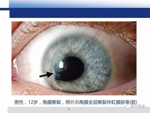 【PPT】眼球损伤影像诊断