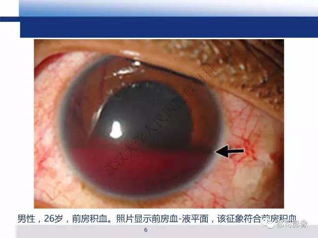 【PPT】眼球损伤影像诊断