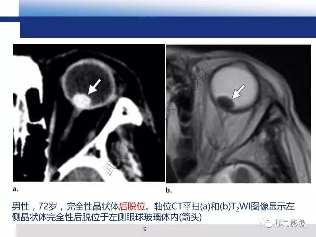【PPT】眼球损伤影像诊断