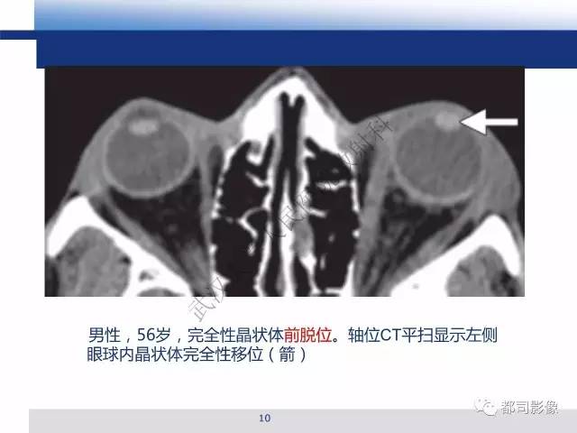 【PPT】眼球损伤影像诊断