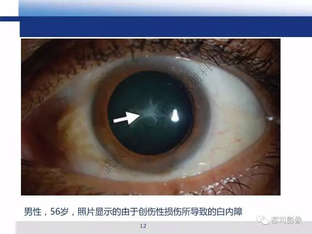 【PPT】眼球损伤影像诊断