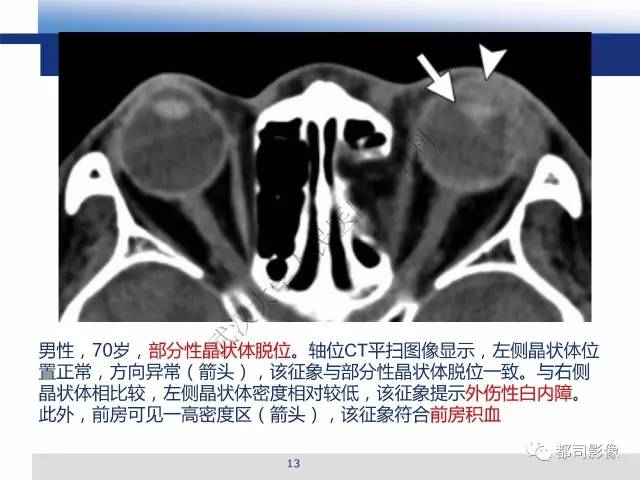 【PPT】眼球损伤影像诊断