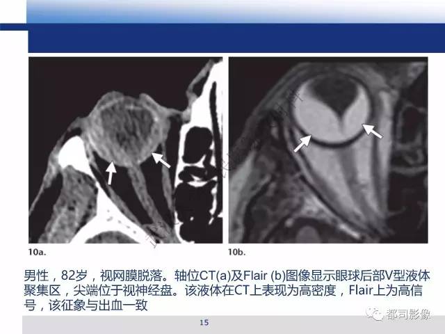【PPT】眼球损伤影像诊断