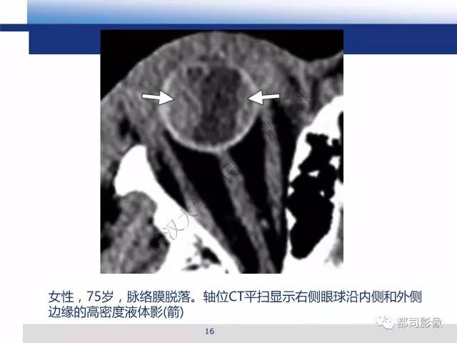 【PPT】眼球损伤影像诊断