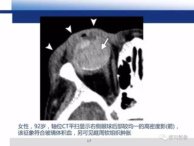 【PPT】眼球损伤影像诊断