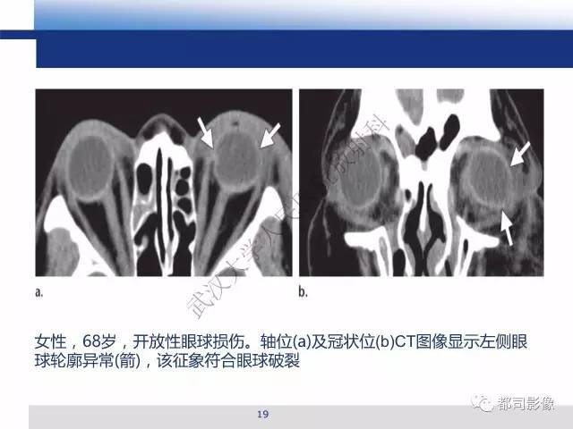 【PPT】眼球损伤影像诊断
